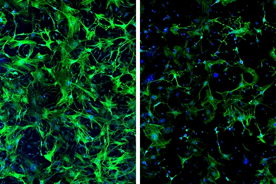 Duke-NUS scientists discover gene that incites excessive scarring in the heart