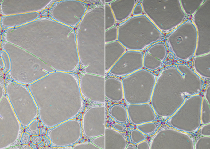 Side by side pictures of cells as seen under the microscope. The left side shows endothelial cells from a healthy individual while the right side shows those from a patient with Alzheimer's disease