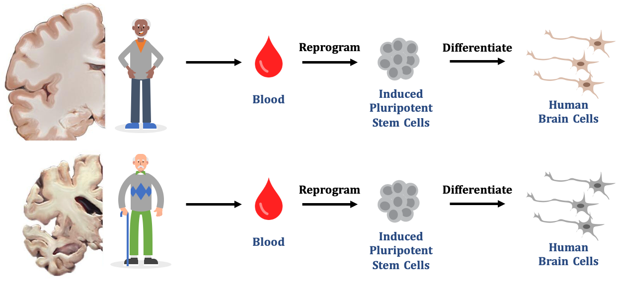 The process of producing induced pluripotent stem cells from blood, which Zhang’s team then uses to grow them into nerve cells // Credit: Zhang Suchun, Duke-NUS